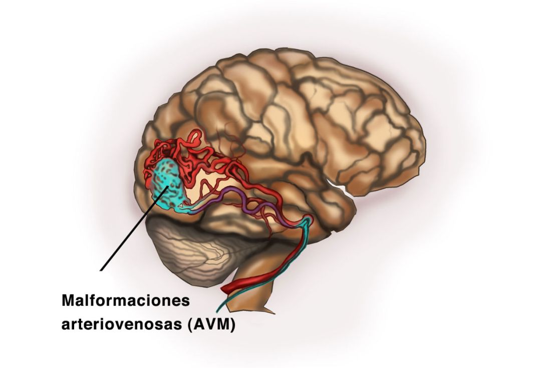 Malformaciones Arteriovenosas Cerebrales (MAV) Malformaciones Arteriovenosas Cerebrales (MAV)